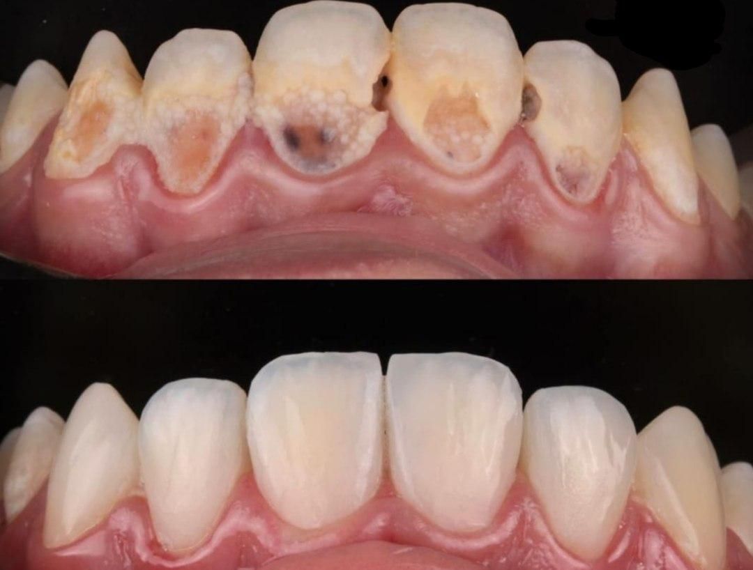 کامپوزیت ایمپلنت ارتودنسی بندرعباس|خدمات آرایشگری و زیبایی|بندرعباس, |دیوار