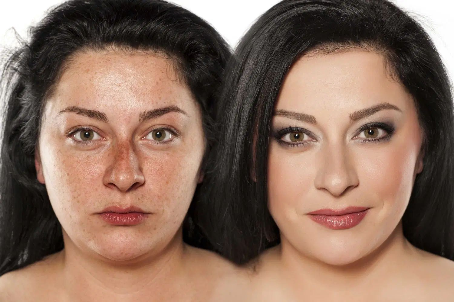 خال صورت/لکه های پوستی/لیزرموسفید/ریموتتو/بوتاکس|خدمات آرایشگری و زیبایی|نجف‌آباد, بازار|دیوار