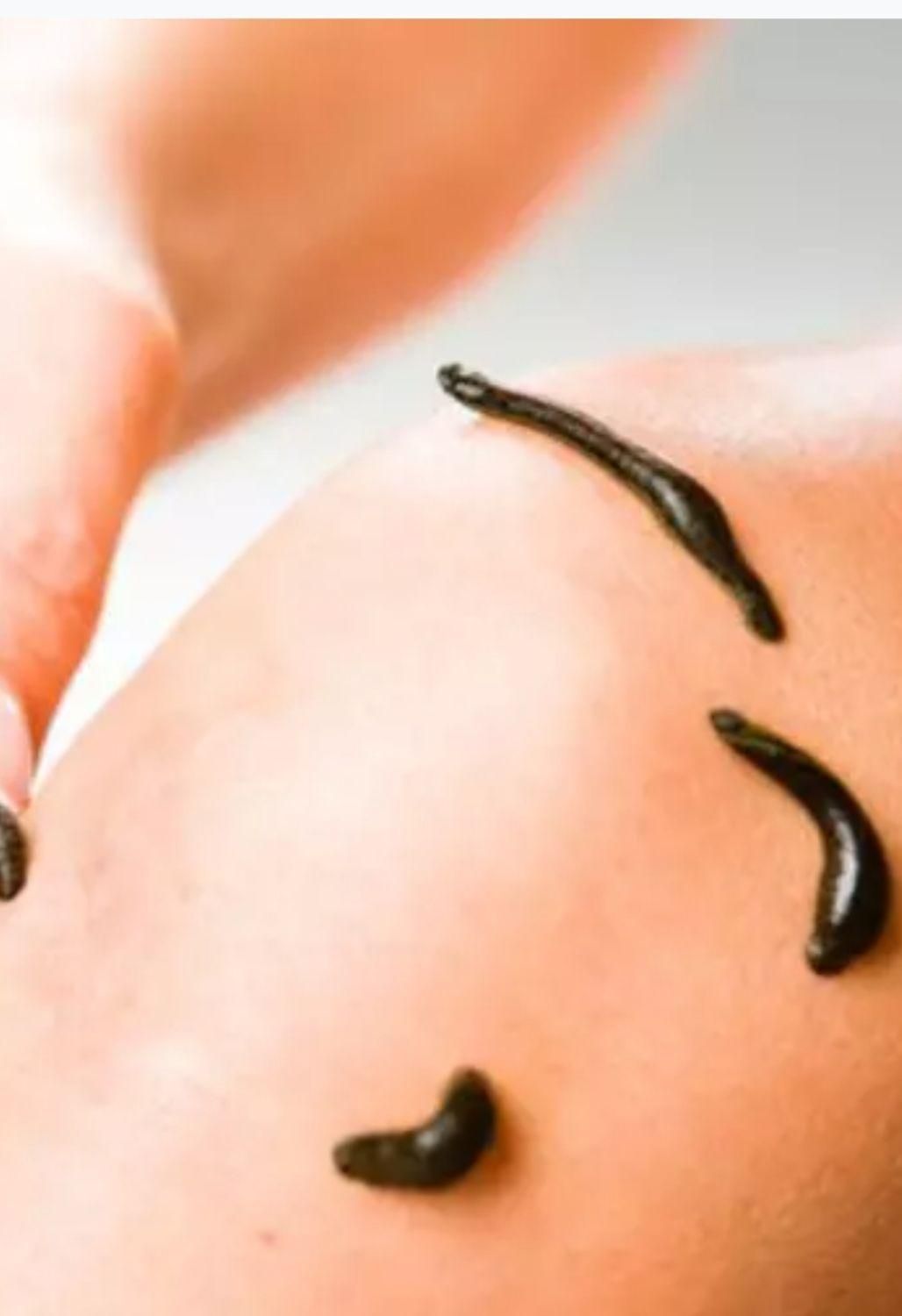 حجامت و زالوتراپی و طب سوزنی‌و پاکسازی بدن از سمو|خدمات آرایشگری و زیبایی|ارومیه, |دیوار