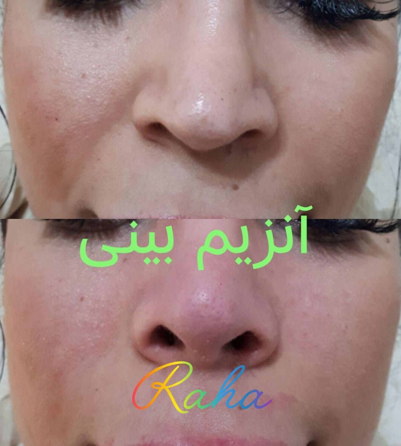 ژل/بوتاکس/آنزیم/مزو فقط ۳۰۰|خدمات آرایشگری و زیبایی|کرج, گوهردشت|دیوار
