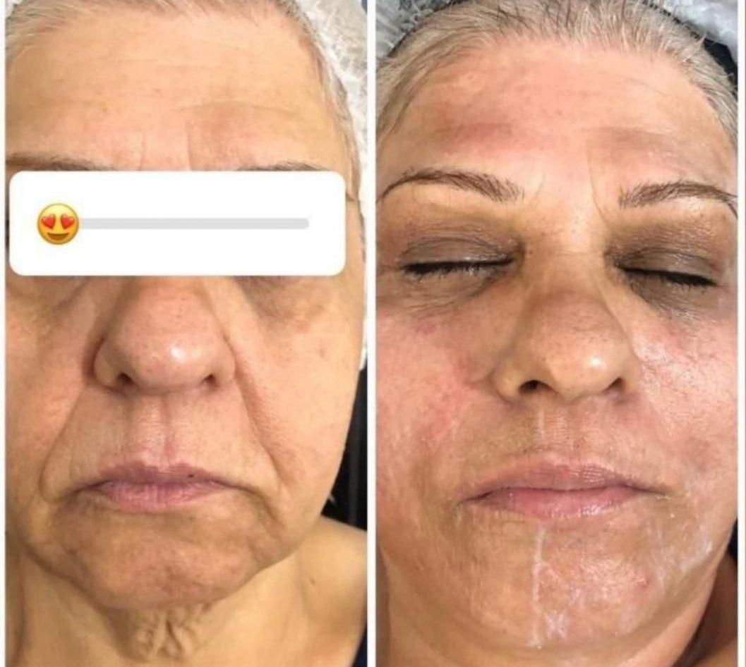 هایفوتراپی جوانسازی آف ویژه|خدمات آرایشگری و زیبایی|قم, شهرک قدس|دیوار