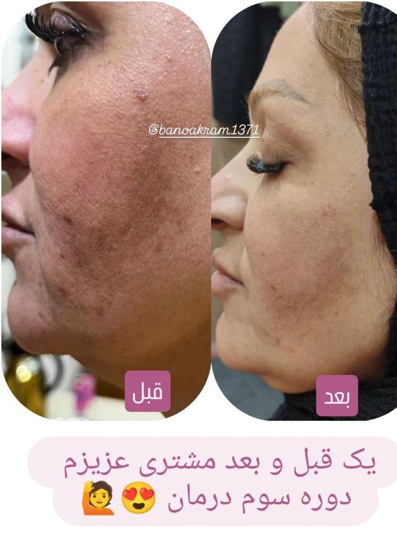 ست کرم مراقبتی روز و شب و دور چشم آنتی ایج|آرایشی، بهداشتی، درمانی|بهبهان, |دیوار