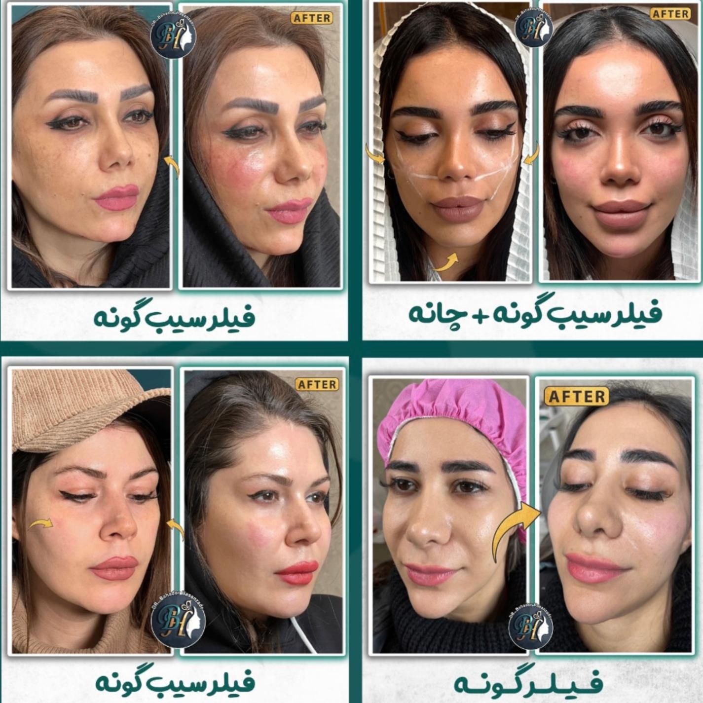 بوتاکس فیلر(ژل) مزوتراپی، پی ار پی درمطب گلسار رشت|خدمات آرایشگری و زیبایی|رشت, گلسار|دیوار