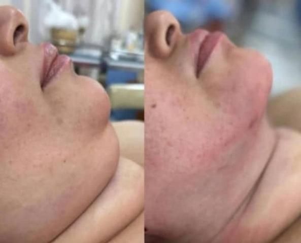 ساکشن(تخلیه) و تزریق بدن و صورت تخصصی در کلینیک|خدمات آرایشگری و زیبایی|اهواز, کیانپارس |دیوار