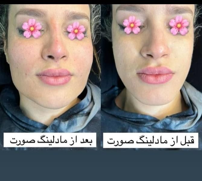 جشنواره تخفیف پی آر پی و ژل و بوتاکس|خدمات آرایشگری و زیبایی|شیراز, زرگری|دیوار