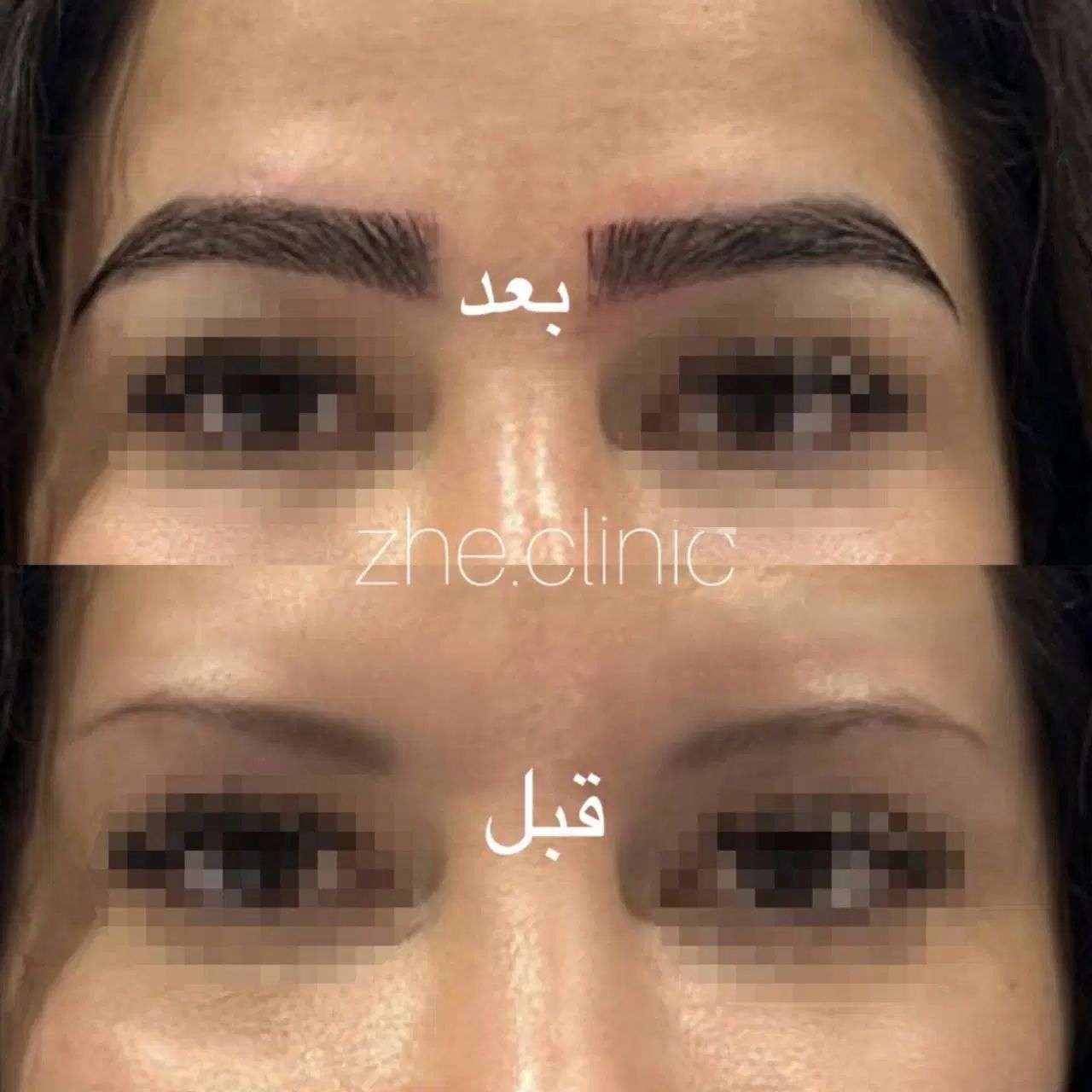 کاشت ابرو فقط ۱۴۹۰۰ با دو جلسه مزو رایگان|خدمات آرایشگری و زیبایی|مشهد, طلاب|دیوار