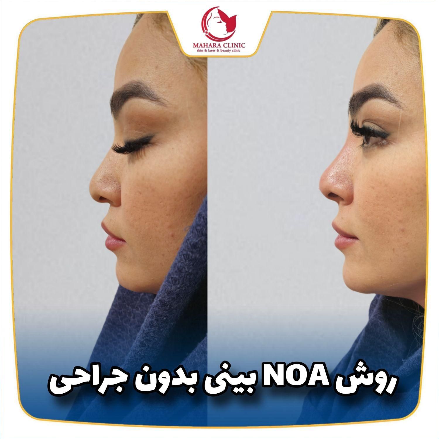 یانگ فیس صورت Noa بینی ابرو غبغب سینه باسن شکم پلک|خدمات آرایشگری و زیبایی|مشهد, هفت تیر (حافظ)|دیوار
