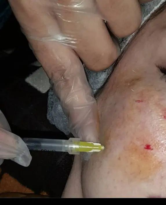 خدمات و آموزش فیشیال مزوتراپی میکروندلینگ|خدمات آرایشگری و زیبایی|اهواز, حصیرآباد|دیوار