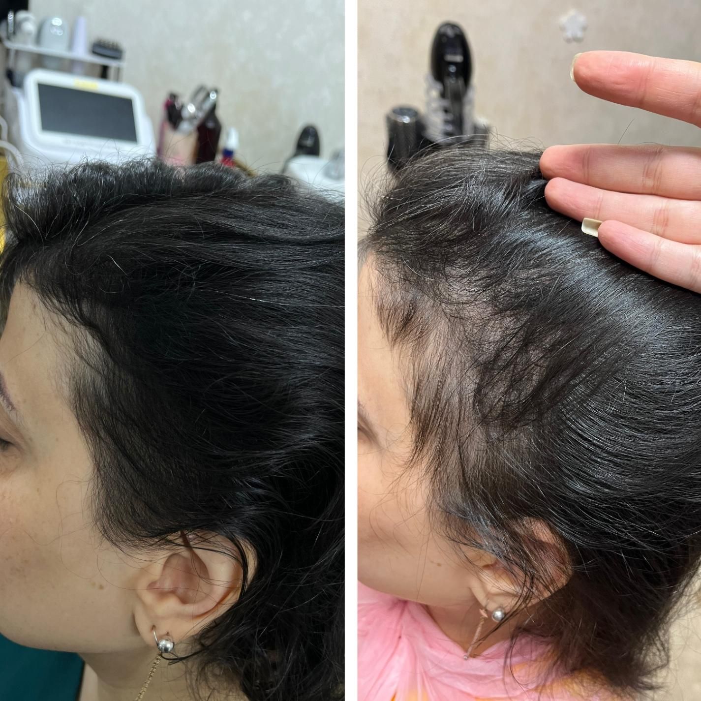 پاکسازی سر،موخوره گیری،اسکالپ،درمان ریزش،رویش مجدد|خدمات آرایشگری و زیبایی|قم, هفت تیر|دیوار
