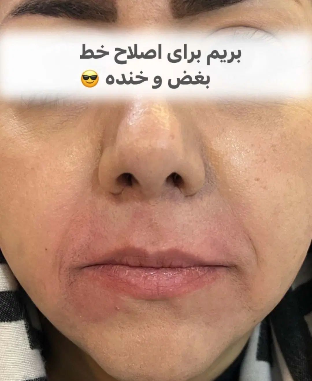 ژل لب فیلر بوتاکس مزو وآنزیم          زیرنظرپزشک|خدمات آرایشگری و زیبایی|مشهد, آزادشهر|دیوار
