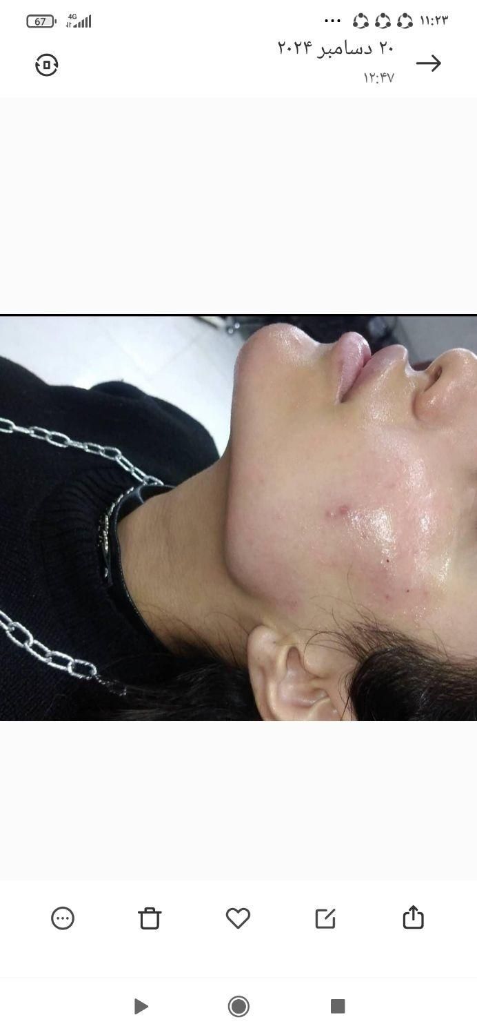 جشنواره باور نکردنی ویژه. ژل و بوتاکس.فیلر مزو ژل|خدمات آرایشگری و زیبایی|شیراز, سینما سعدی|دیوار
