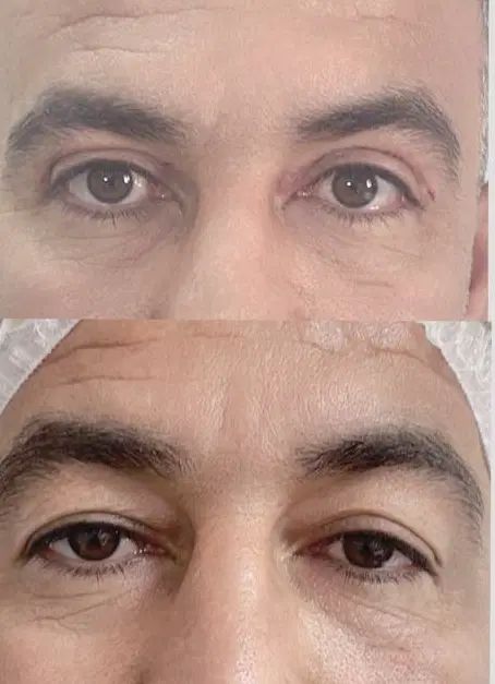 بلفاروپلاستی/ جراحی پلک / لیفت ابرو/ سانترال لب|خدمات آرایشگری و زیبایی|تهران, صادقیه|دیوار