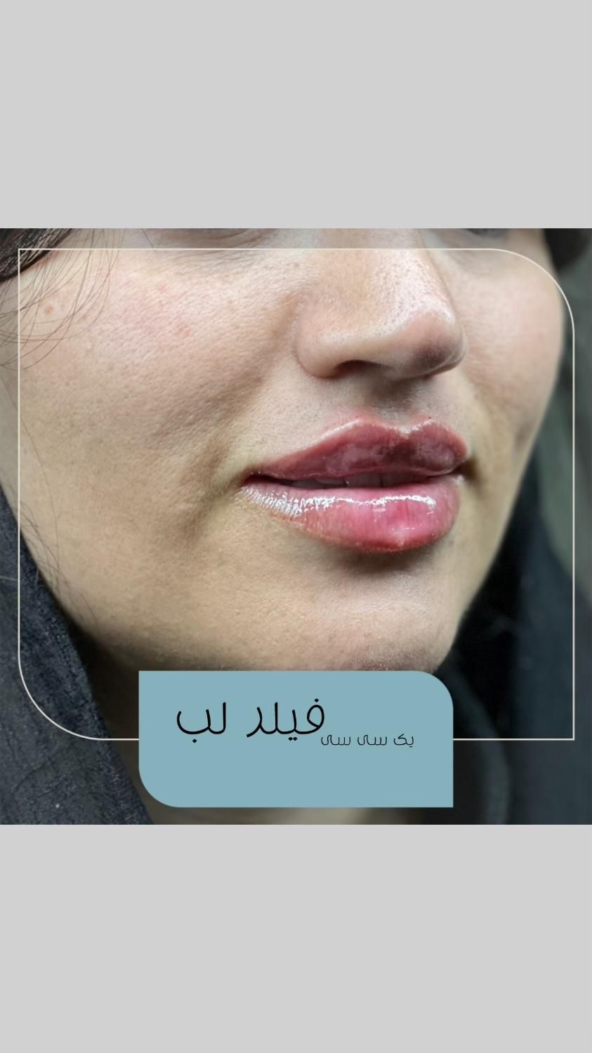 تزریق ژل از ۱۴۹۰ ،بوتاکس از ۶۵۰، پکیج فول فیس ۹/۵|خدمات آرایشگری و زیبایی|تهران, گلستان (شهرک راه آهن)|دیوار