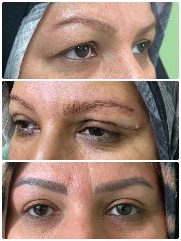 بلفاروپلاستی،ساکشن غبغب،تزریق چربی کاشت مو و ابرو|خدمات آرایشگری و زیبایی|شاهینشهر, فردوسی|دیوار