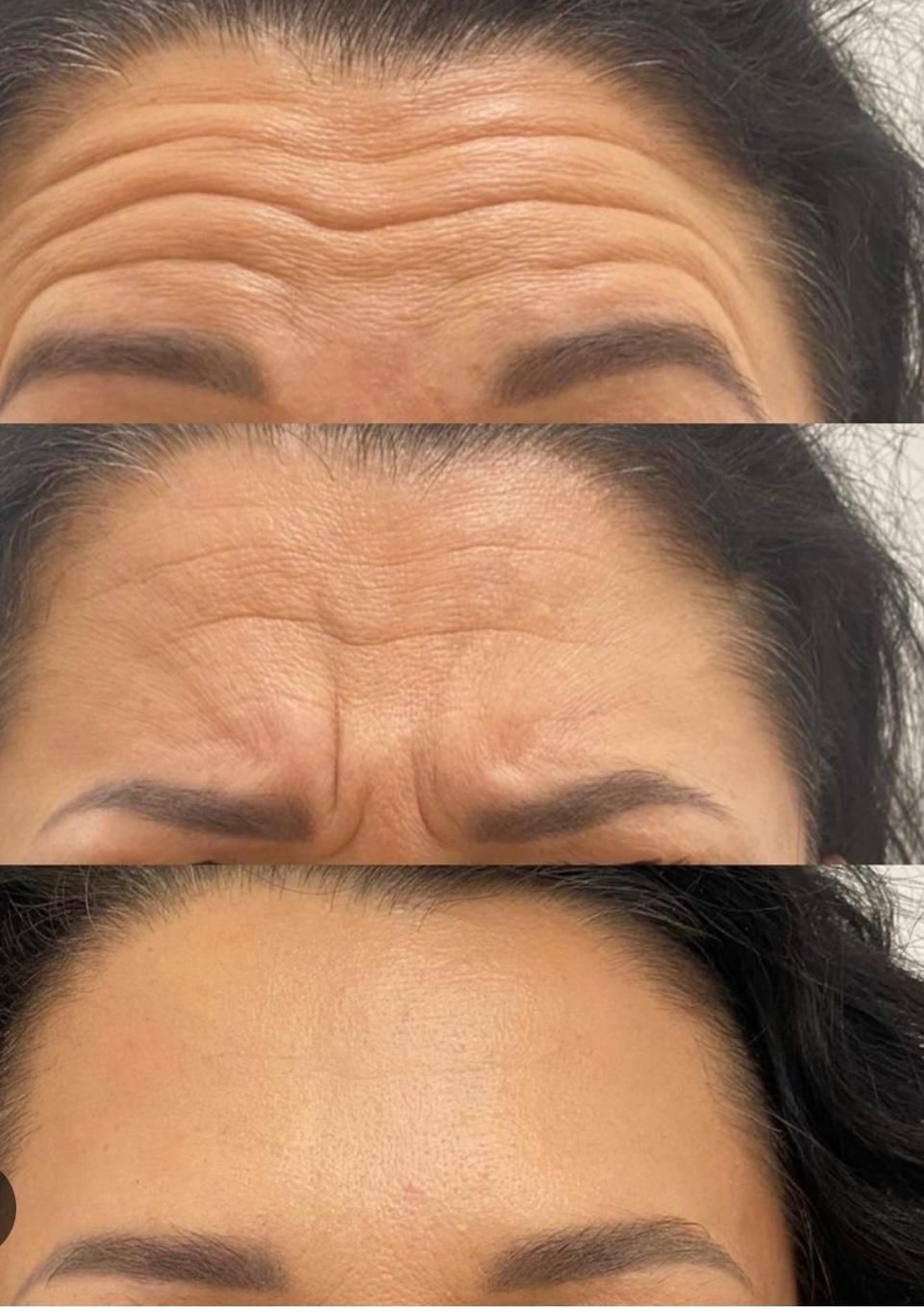 تزریق ژل و بوتاکس|خدمات آرایشگری و زیبایی|اصفهان, سنبلستان|دیوار