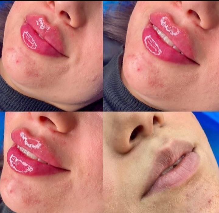 ژل و بوتاکس باکمترین قیمت در مطب زیبایی شفاطب|خدمات آرایشگری و زیبایی|تبریز, |دیوار