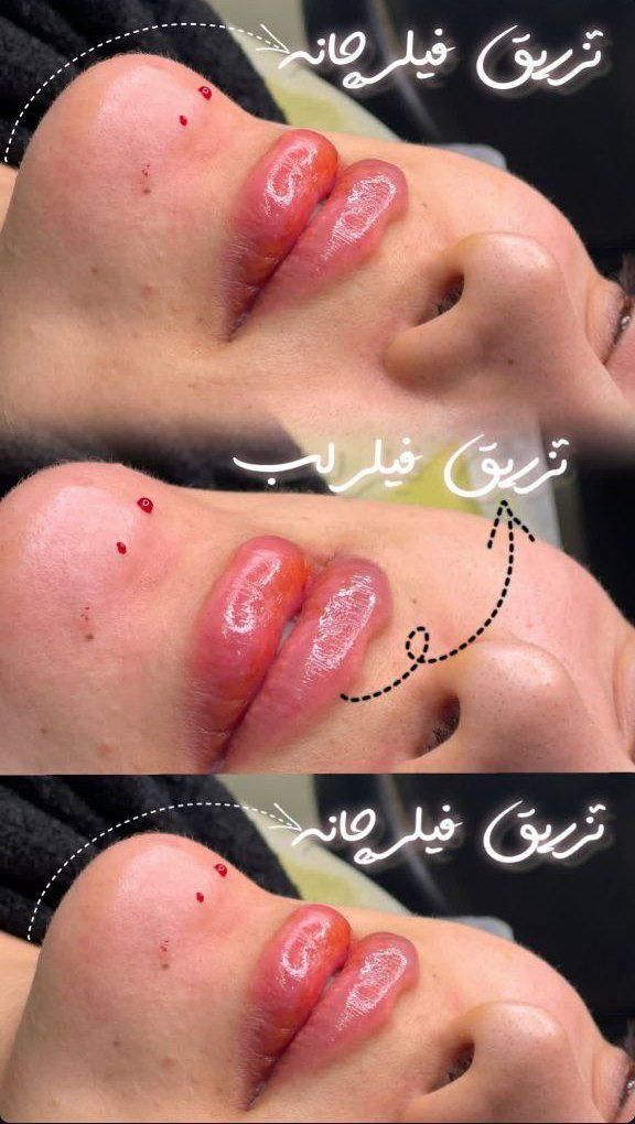 مرکز تخصصی تزریق چربی/فیلرلب و صورت/نخ لیفت/بوتاکس|خدمات آرایشگری و زیبایی|مشهد, سجاد شهر|دیوار