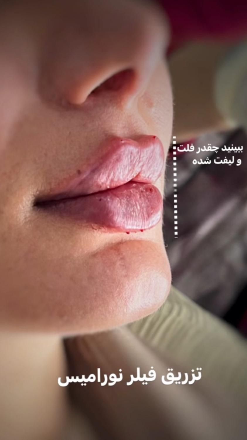 جشنواره پی آرپی ژل و بوتاکس مزوتراپی بلفارو|خدمات آرایشگری و زیبایی|اهواز, کیانپارس |دیوار