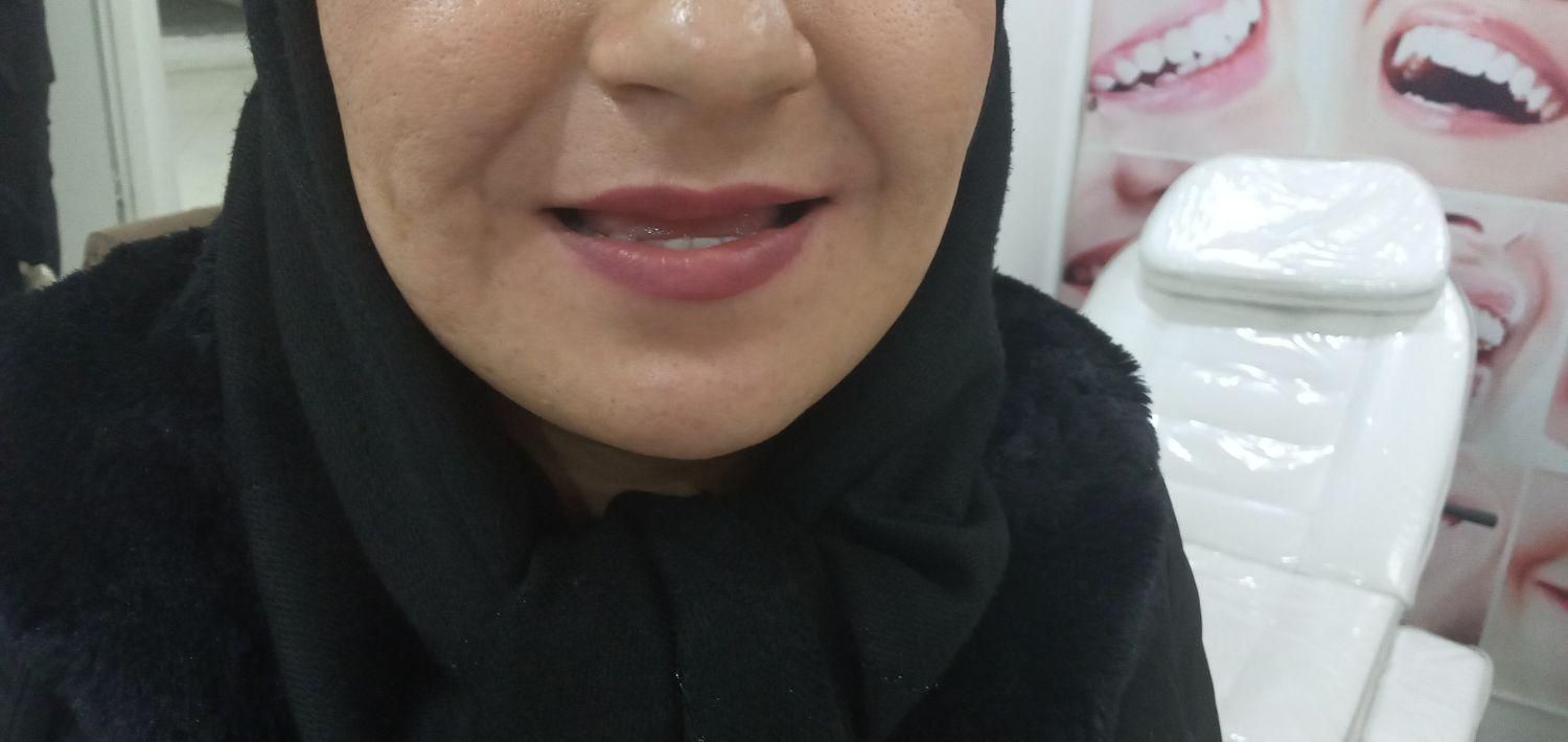 دندانسازی ( پروتز متحرک) لمینتی و کامپوزیتی|خدمات آرایشگری و زیبایی|مشهد, احمدآباد|دیوار
