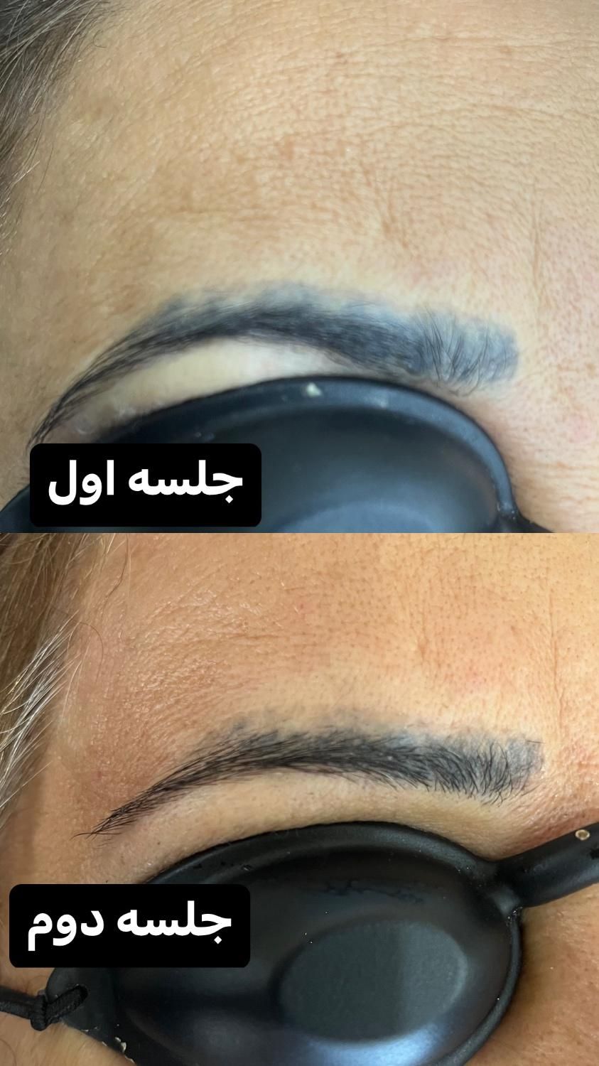 خدمات ریمو تتو،رفع کک و مک کلینک دکتر شریفی|خدمات آرایشگری و زیبایی|فولادشهر, B4|دیوار