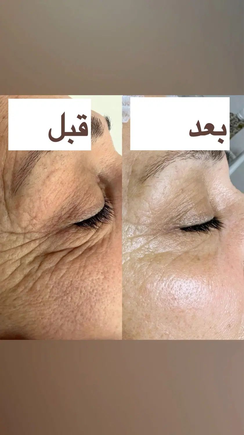 جوانسازی فوری/در یک جلسه/در یک ساعت|خدمات آرایشگری و زیبایی|رشت, کوی حسینی|دیوار