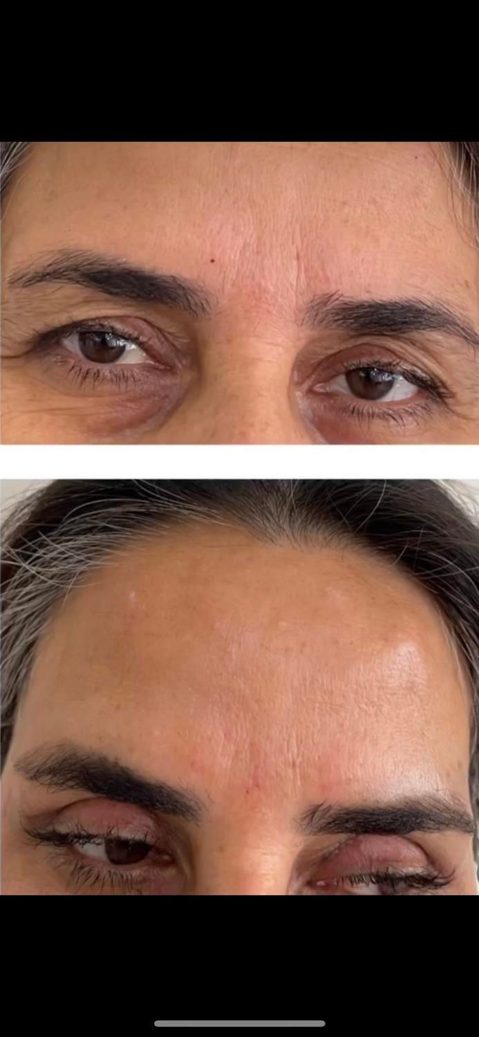 تزریق بوتاکس کل صورت و زیر بغل|خدمات آرایشگری و زیبایی|کرمانشاه, |دیوار