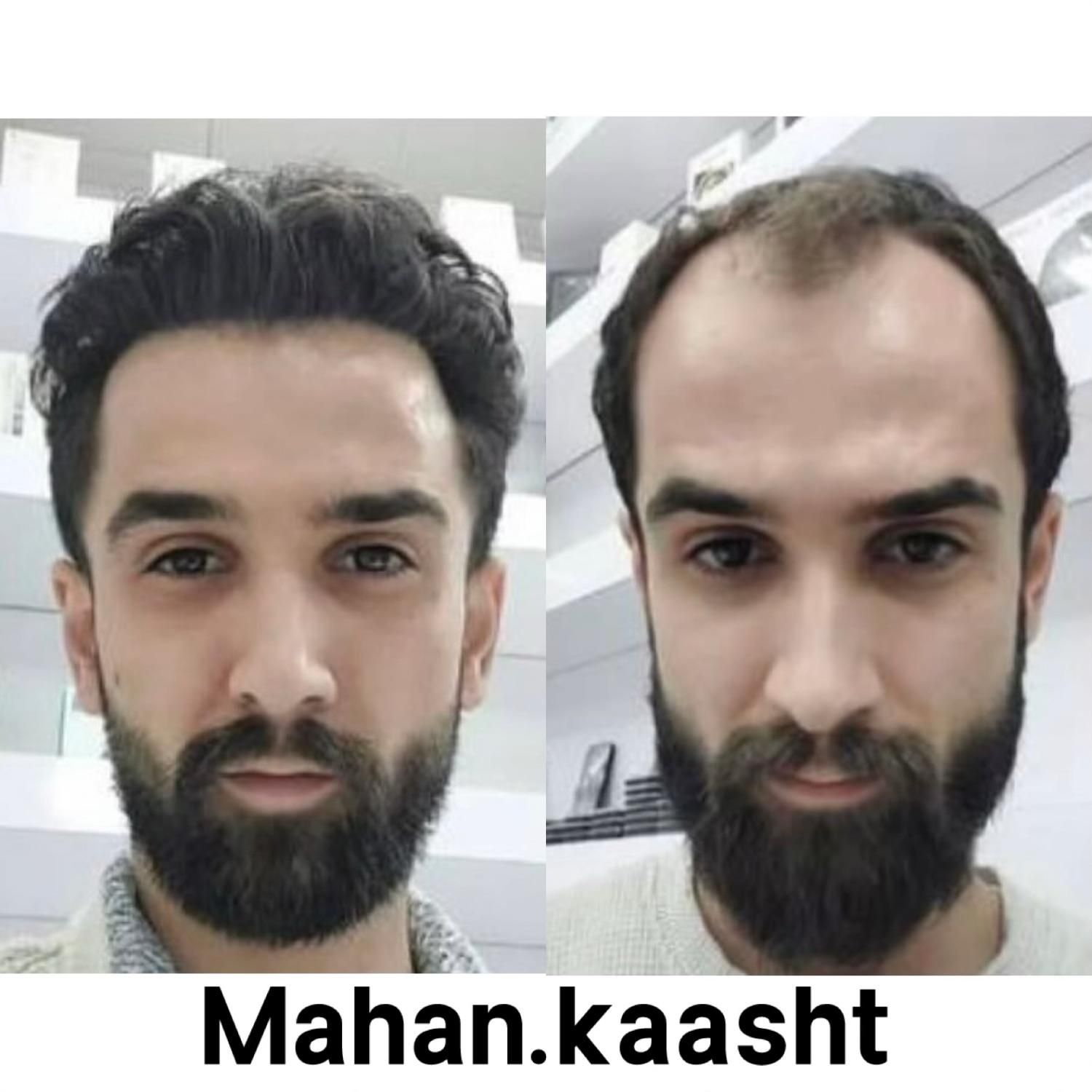کاشت مو و ابرو اقساطی حتی با سفته|خدمات آرایشگری و زیبایی|مشهد, وکیل‌آباد|دیوار