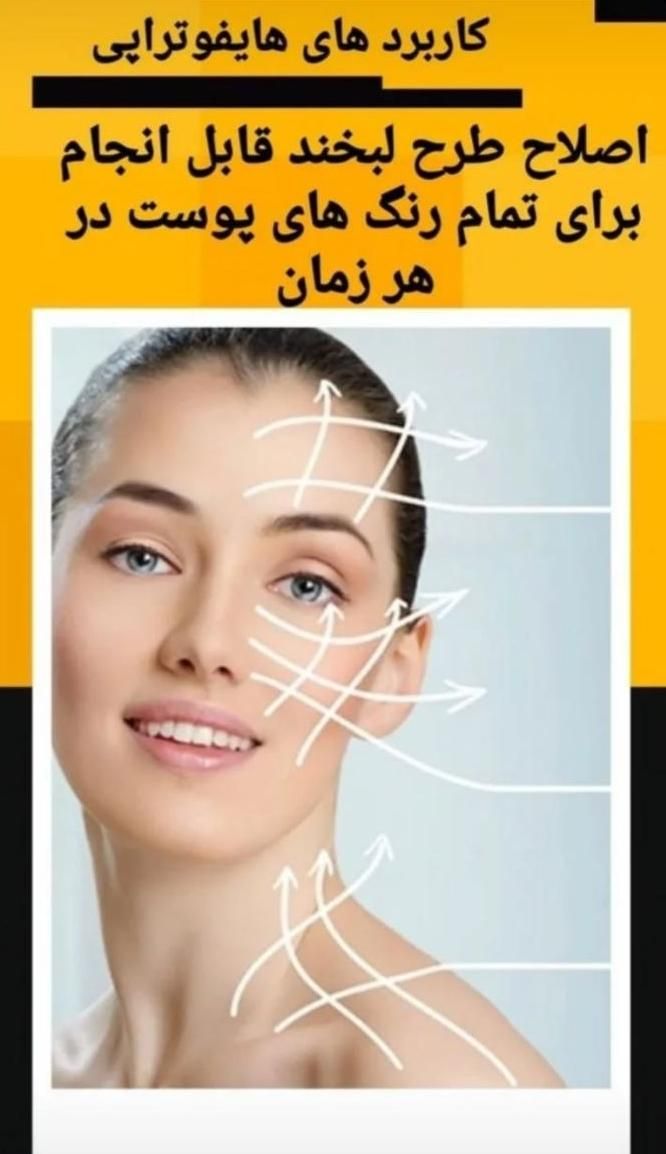 مدل برای هایفوتراپی فقط باقیمت استثنایی 950تومان|خدمات آرایشگری و زیبایی|تبریز, |دیوار