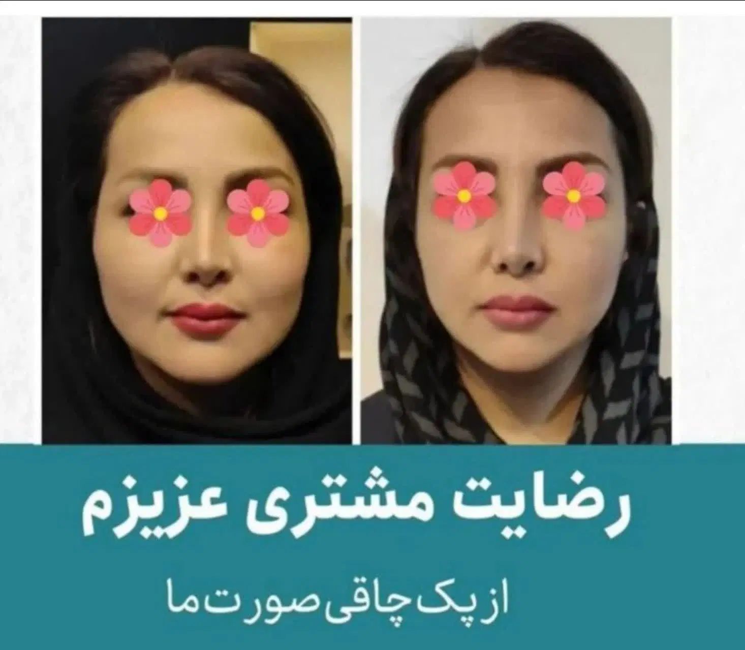 چاقی صورت بدون بازگشت وتضمینی(با جوانه گندم)|آرایشی، بهداشتی، درمانی|جیرفت, |دیوار