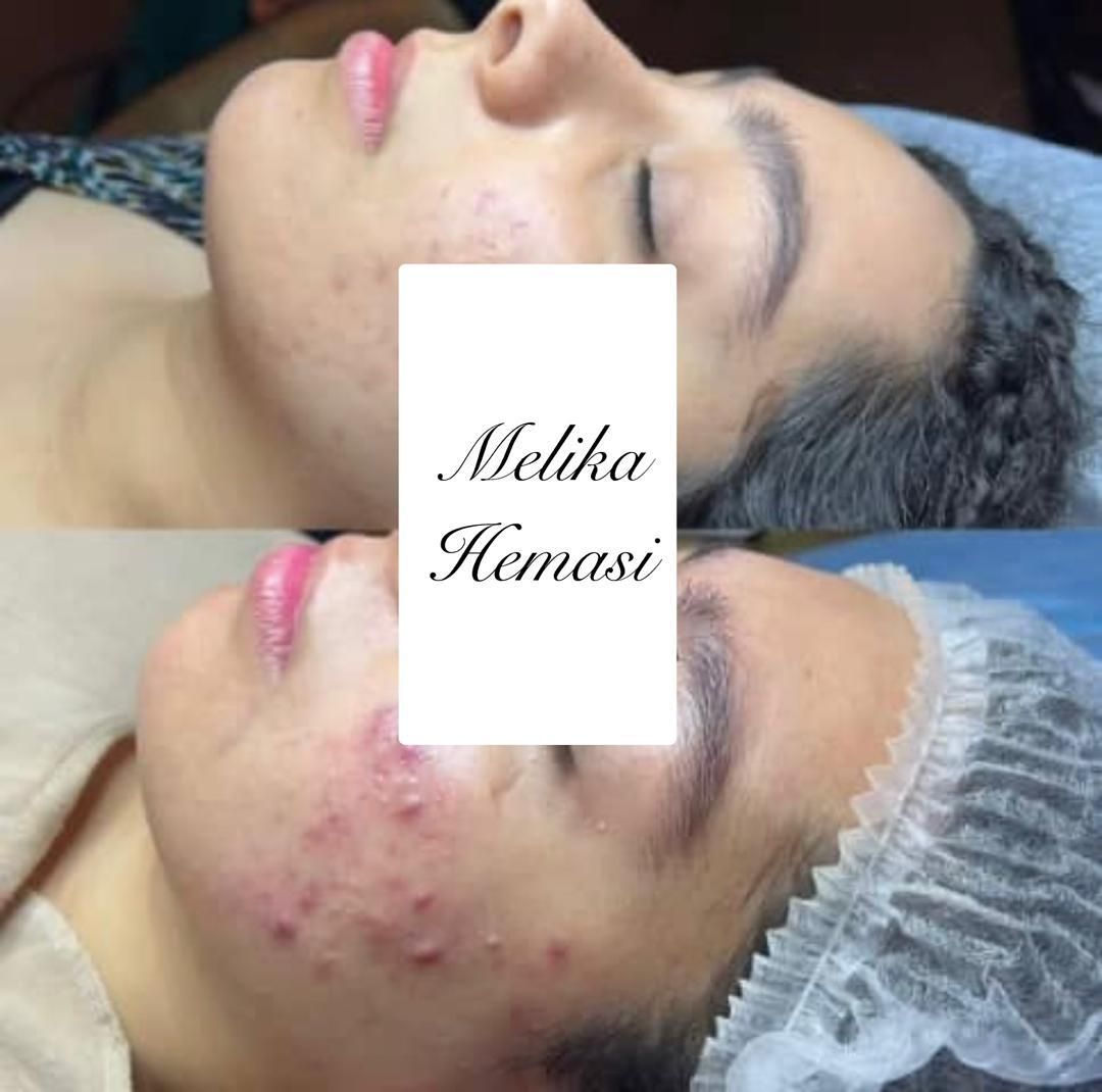 فیشیال و جوانسازی و پاکسازی صورت|خدمات آرایشگری و زیبایی|اصفهان, خلجا|دیوار