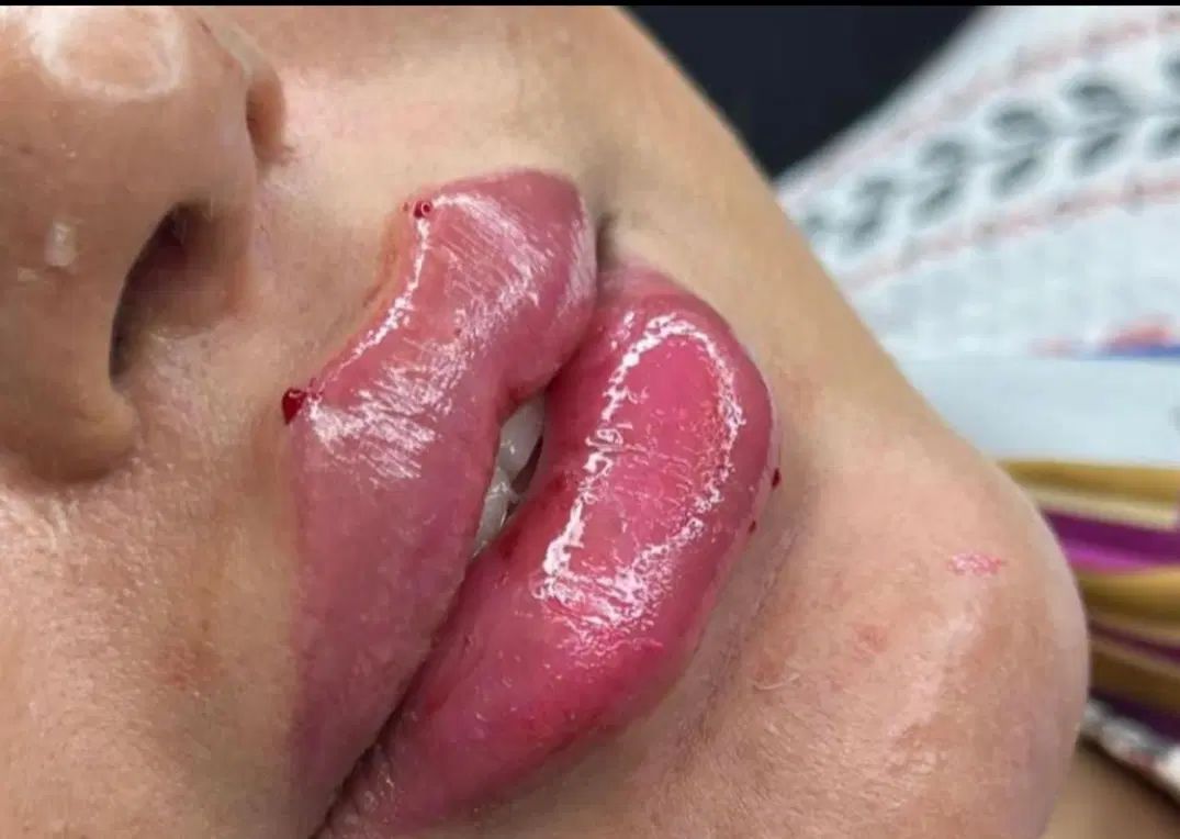 ژل وبوتاکس نخ فیلربادی توسط پزشک|خدمات آرایشگری و زیبایی|تهران, جمهوری|دیوار