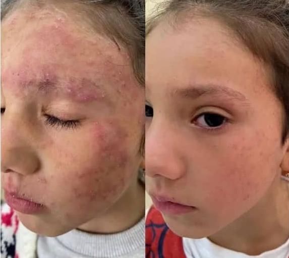 درمان تضمینی پیسی و پسوریازیس|خدمات آرایشگری و زیبایی|مشهد, انقلاب|دیوار