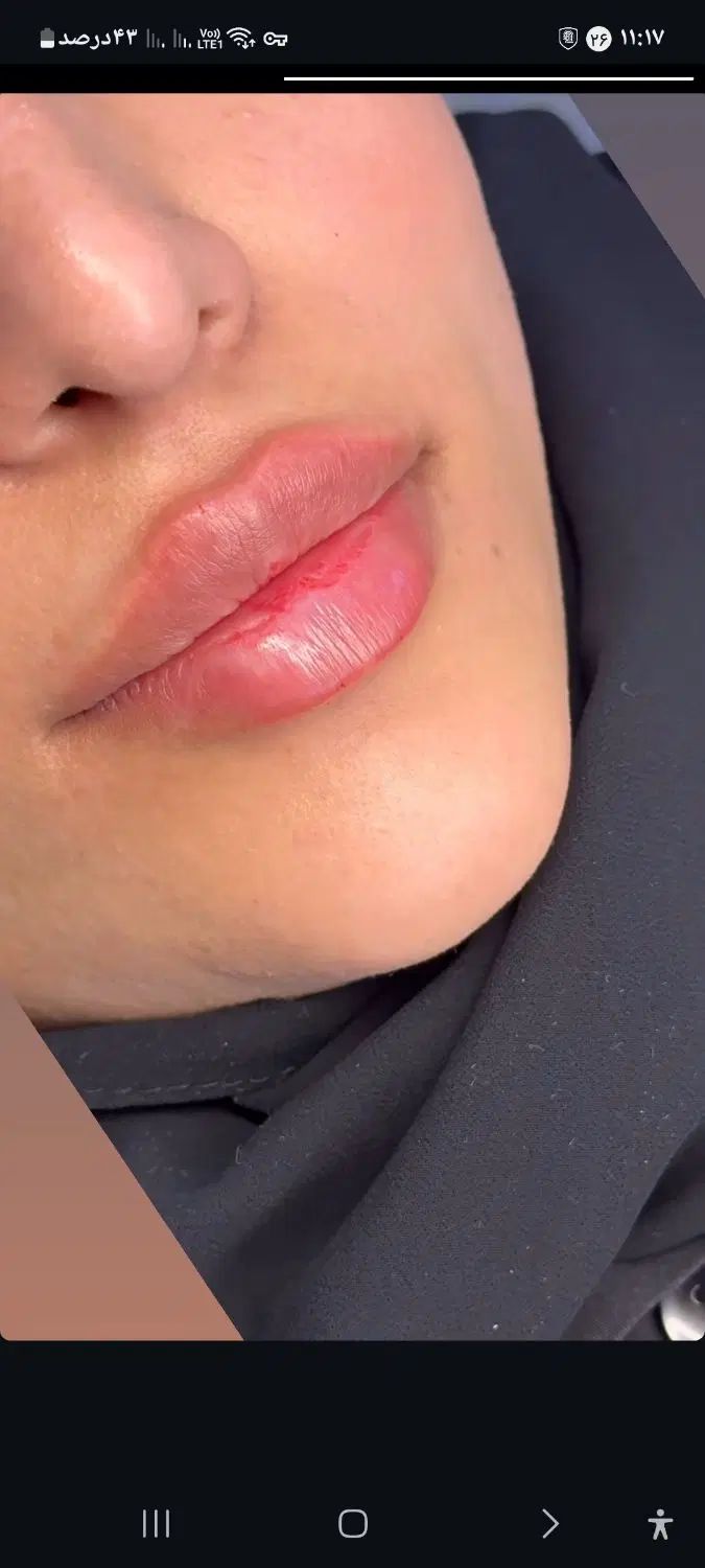 ژل بوتاکس آنزیم مزوتراپی پرسینگ فشیال فیلر|خدمات آرایشگری و زیبایی|مشهد, صیاد شیرازی|دیوار