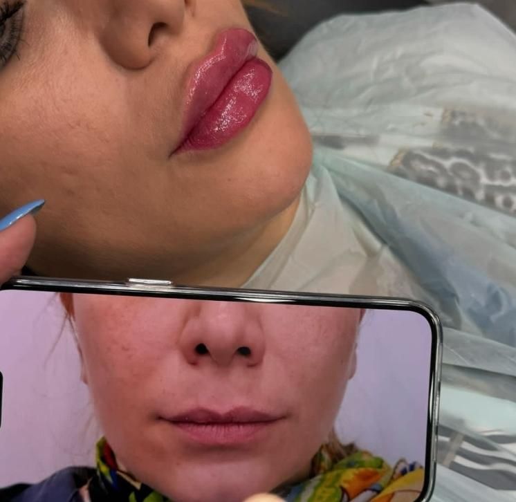 مطب تزریق ژل لب روسی فیلر بوتاکس مزوتراپی مزوژل|خدمات آرایشگری و زیبایی|ساری, |دیوار