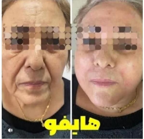 جشنواره لیفت/جوانسازی/انواع هایفو/در1جلسه فقط ۸۹۰ت|خدمات آرایشگری و زیبایی|اصفهان, ناژوان|دیوار