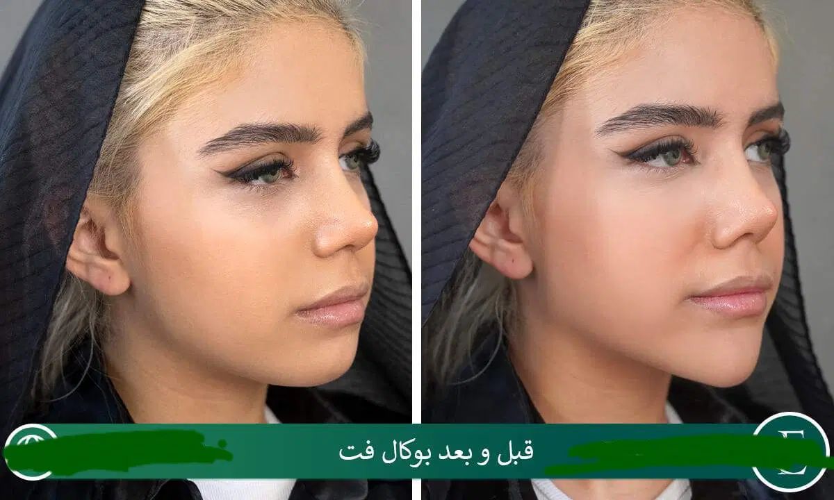 ساکشن غبغب وبوکال فت و چال گونه توسط پزشک در مطب|خدمات آرایشگری و زیبایی|مشهد, شهید فرامرز عباسی|دیوار