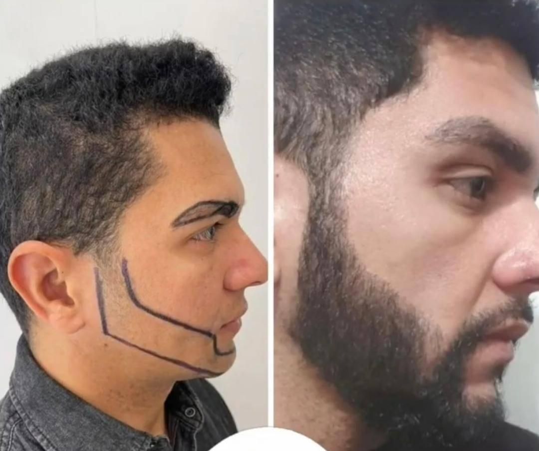 کاشت مو ابرو و ریش تارکوب|خدمات آرایشگری و زیبایی|نظرآباد, |دیوار