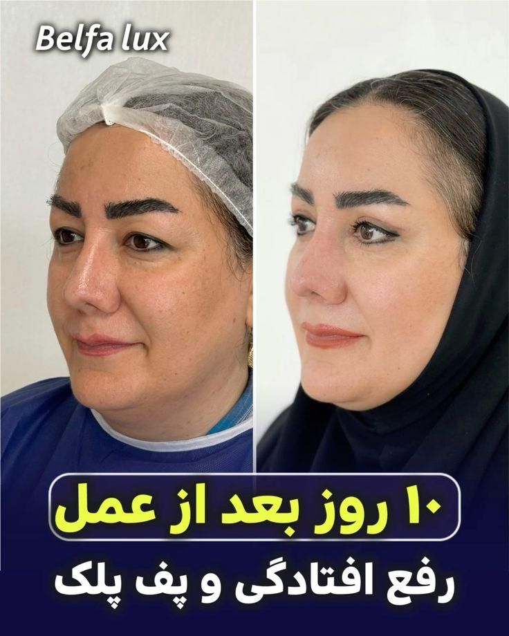 تخفیف ژل ،بوتاکس ،جوانساز،فیلر،ساکشن|خدمات آرایشگری و زیبایی|کرج, گلشهر|دیوار