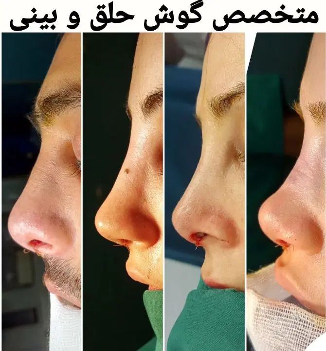 عمل رینوپلاستی و جراحی بینی عمل انحراف بینی|خدمات آرایشگری و زیبایی|اهواز, گلستان|دیوار