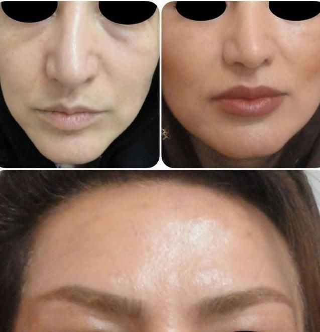 مطب پوست موزیبایی لیزرحذف تتوبالیزرQsبا۱۷سال تجربه|خدمات آرایشگری و زیبایی|تبریز, |دیوار