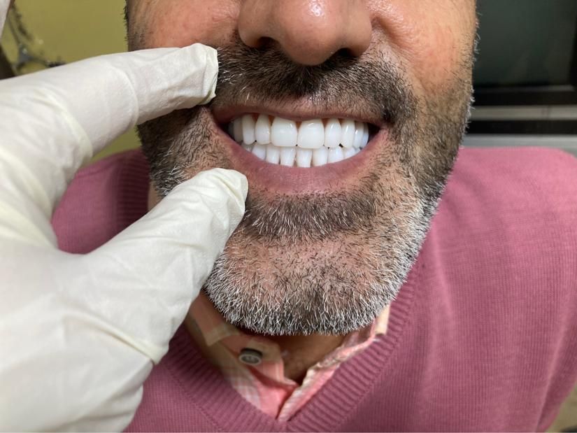 دندان مصنوعی لبخند (ضمانت ۱۰ ساله/تحویل ۳تا ۷ روز)|خدمات آرایشگری و زیبایی|کرج, اصفهانیها|دیوار