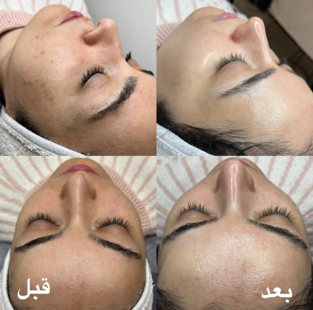 به چند نفر برای مدل پاکسازی پوست لازم دارم|خدمات آرایشگری و زیبایی|شاهین دژ, |دیوار