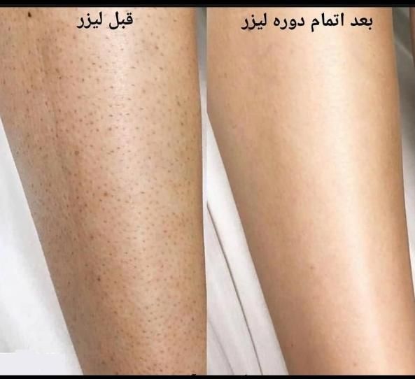 لـیزر موهای زائد/الکساندرایت/پی ار پی/پاککردن تاتو|خدمات آرایشگری و زیبایی|مشهد, آزادشهر|دیوار