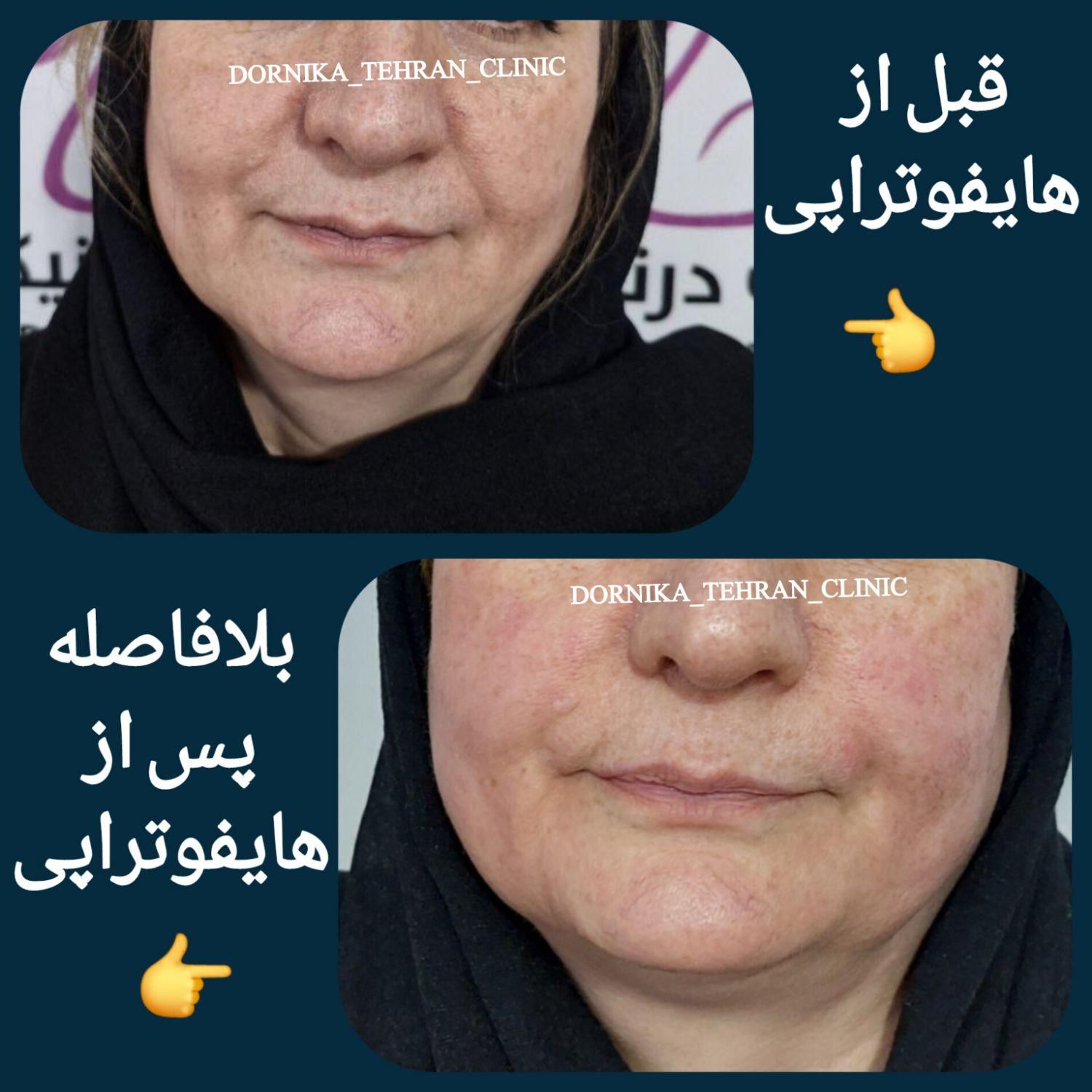 ** جوانسازی پوست با هایفو تنها ۹۸۰ هزار **|خدمات آرایشگری و زیبایی|تهران, نازی‌آباد|دیوار