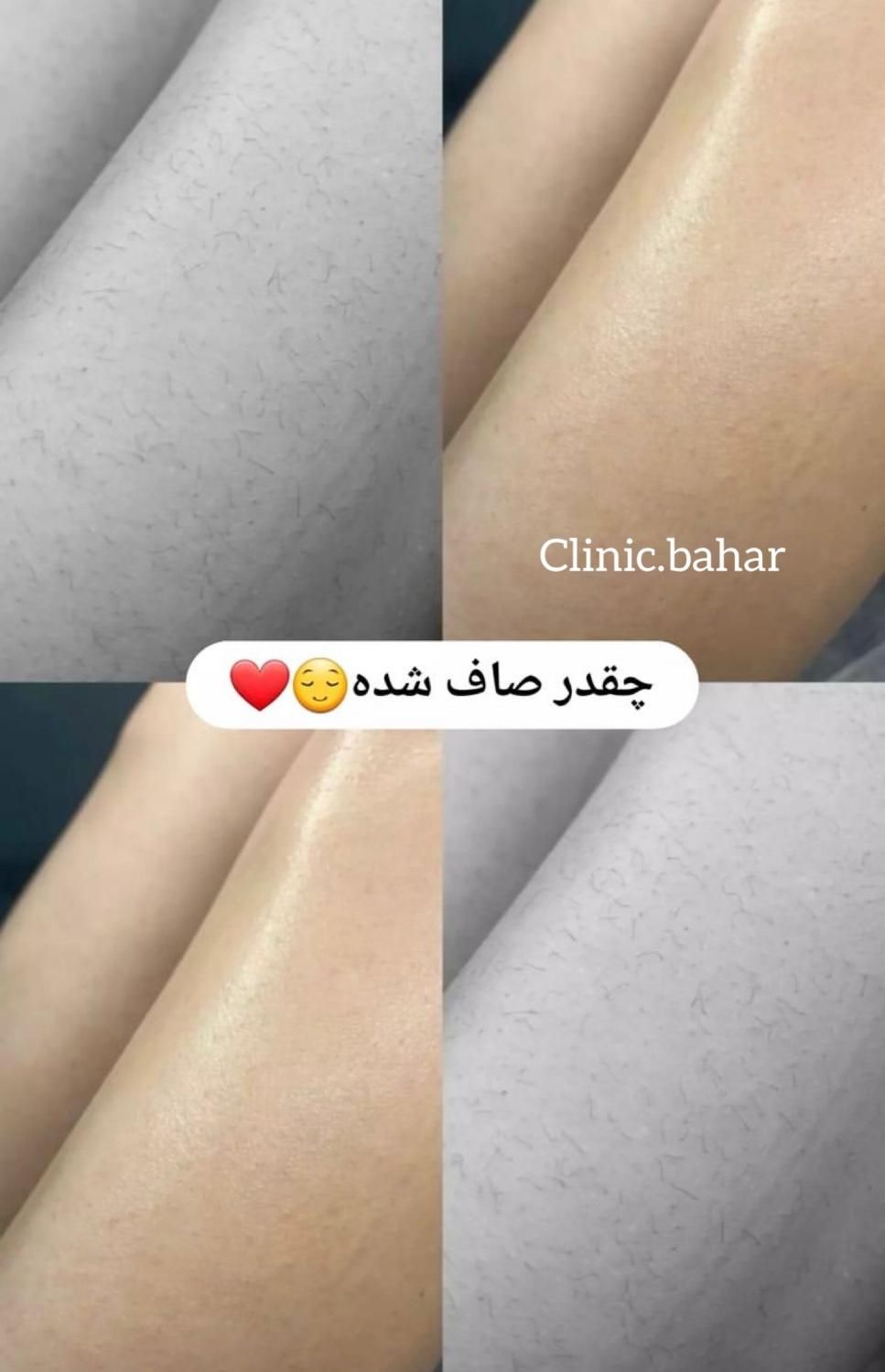 لیزر بدن تضمینیِ تضمینی با سفیدکنندگی بدن|خدمات آرایشگری و زیبایی|گرگان, |دیوار