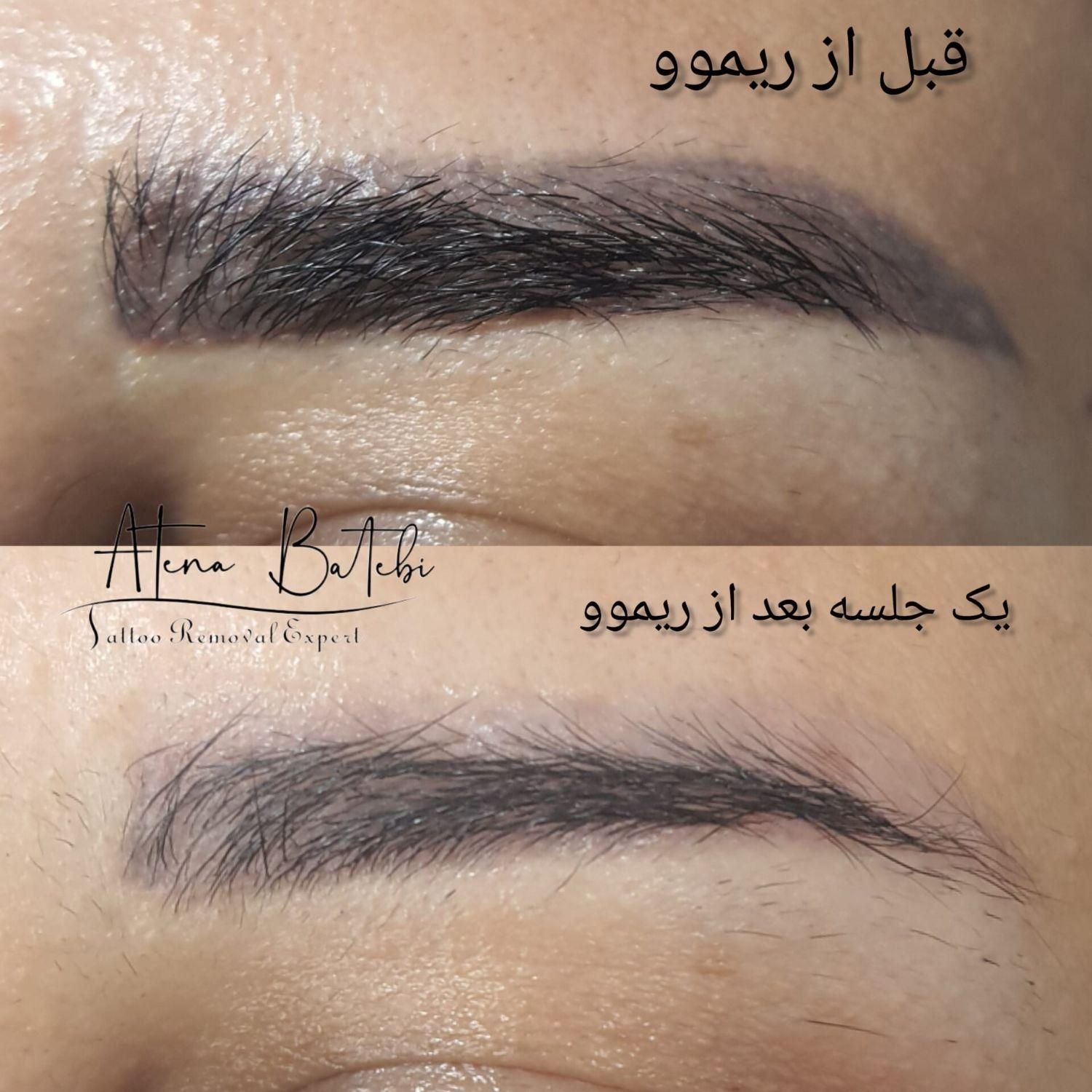 خدمات و آموزش تخصصی ریموو تتو تک جلسه ای،تتو بدن|خدمات آرایشگری و زیبایی|رشت, گلسار|دیوار