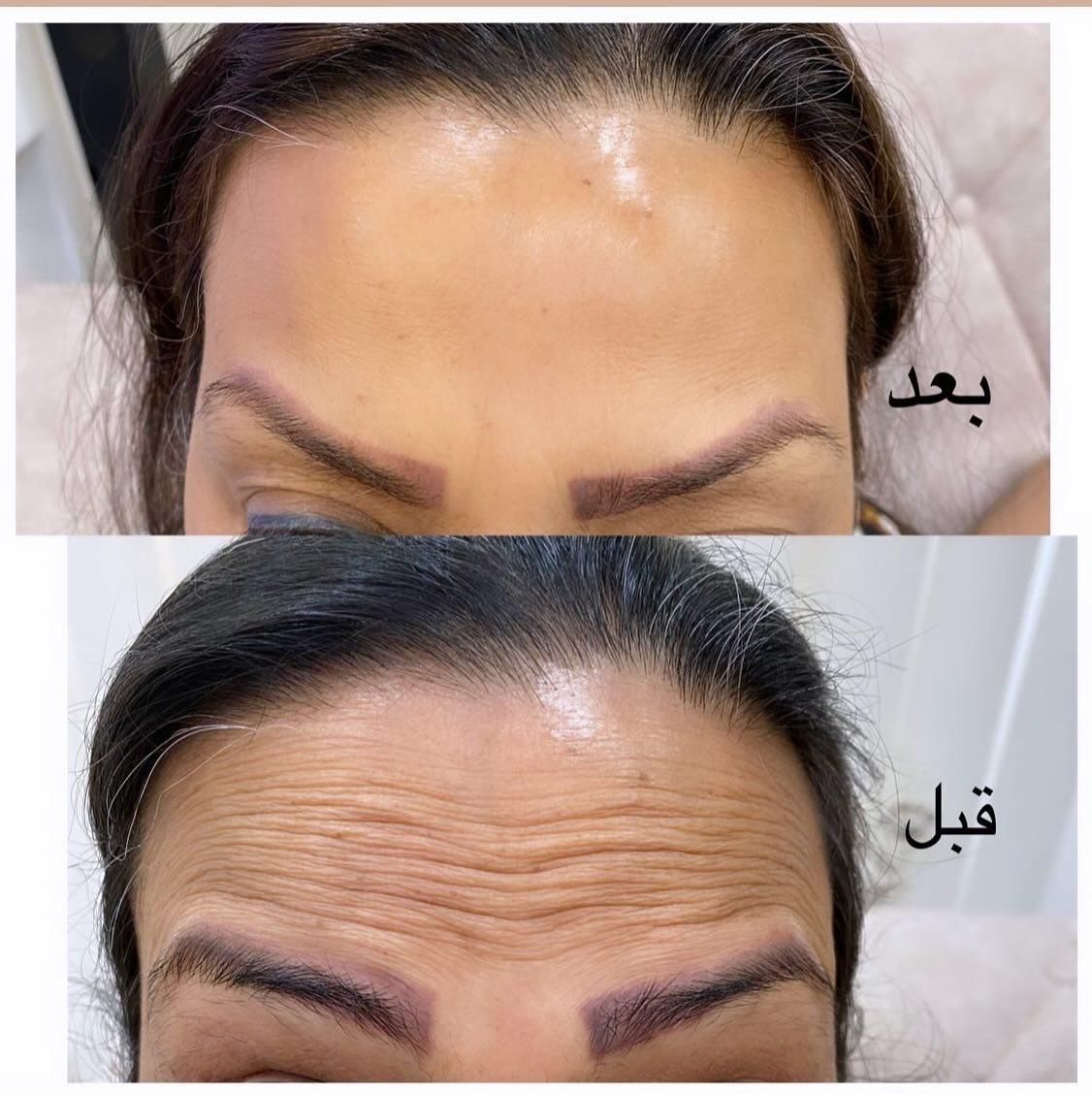 لیزر خال برداری.جوانسازی شهرری|خدمات آرایشگری و زیبایی|ری, جوانمرد قصاب|دیوار