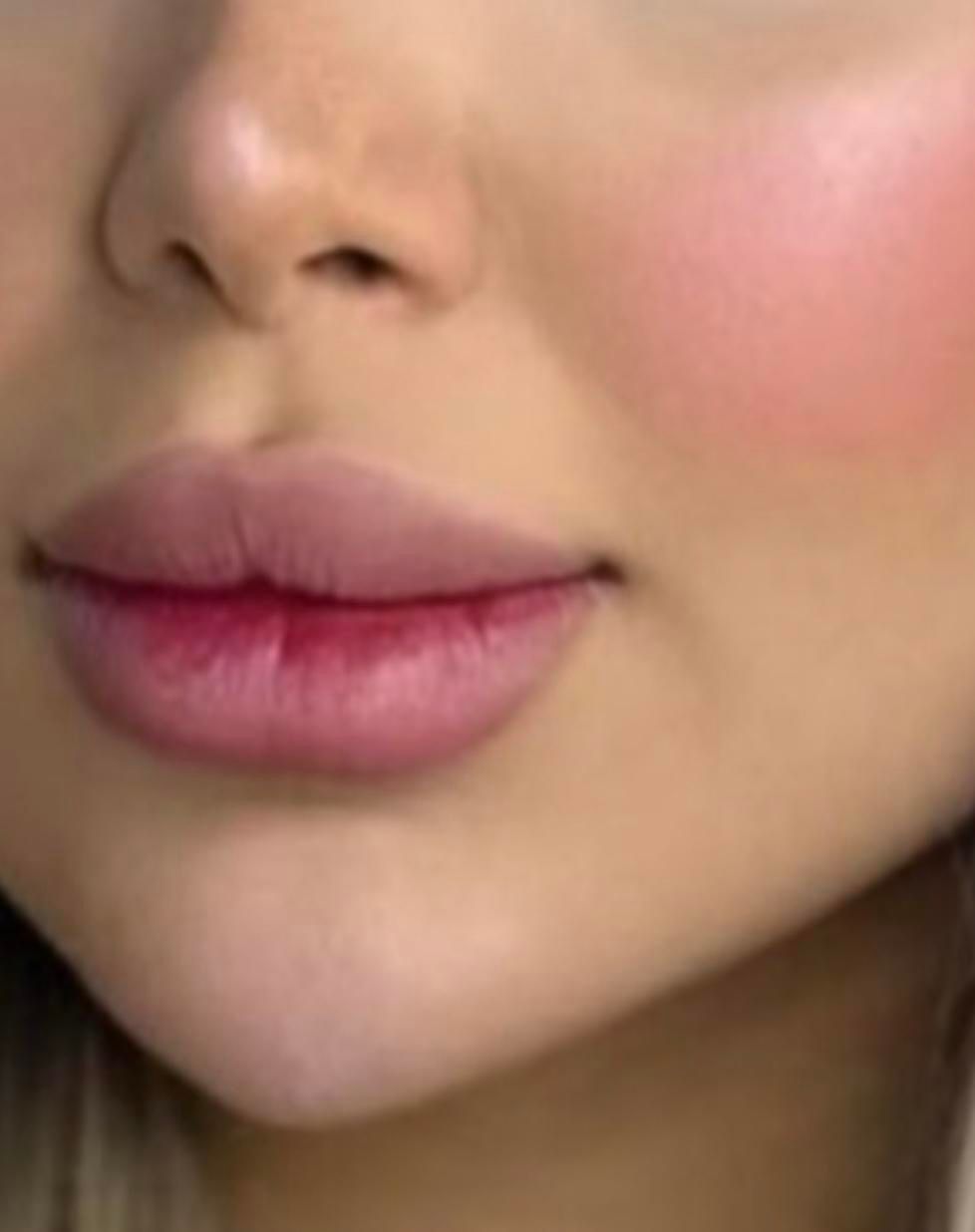 تزریق ژل بوتاکس توسط پزشک|خدمات آرایشگری و زیبایی|کرمانشاه, |دیوار