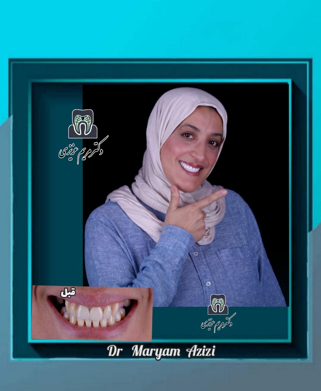 دندانپزشکی ترمیم دندان با مواد کامپوزیت دندان|خدمات آرایشگری و زیبایی|شیراز, معالی‌آباد|دیوار