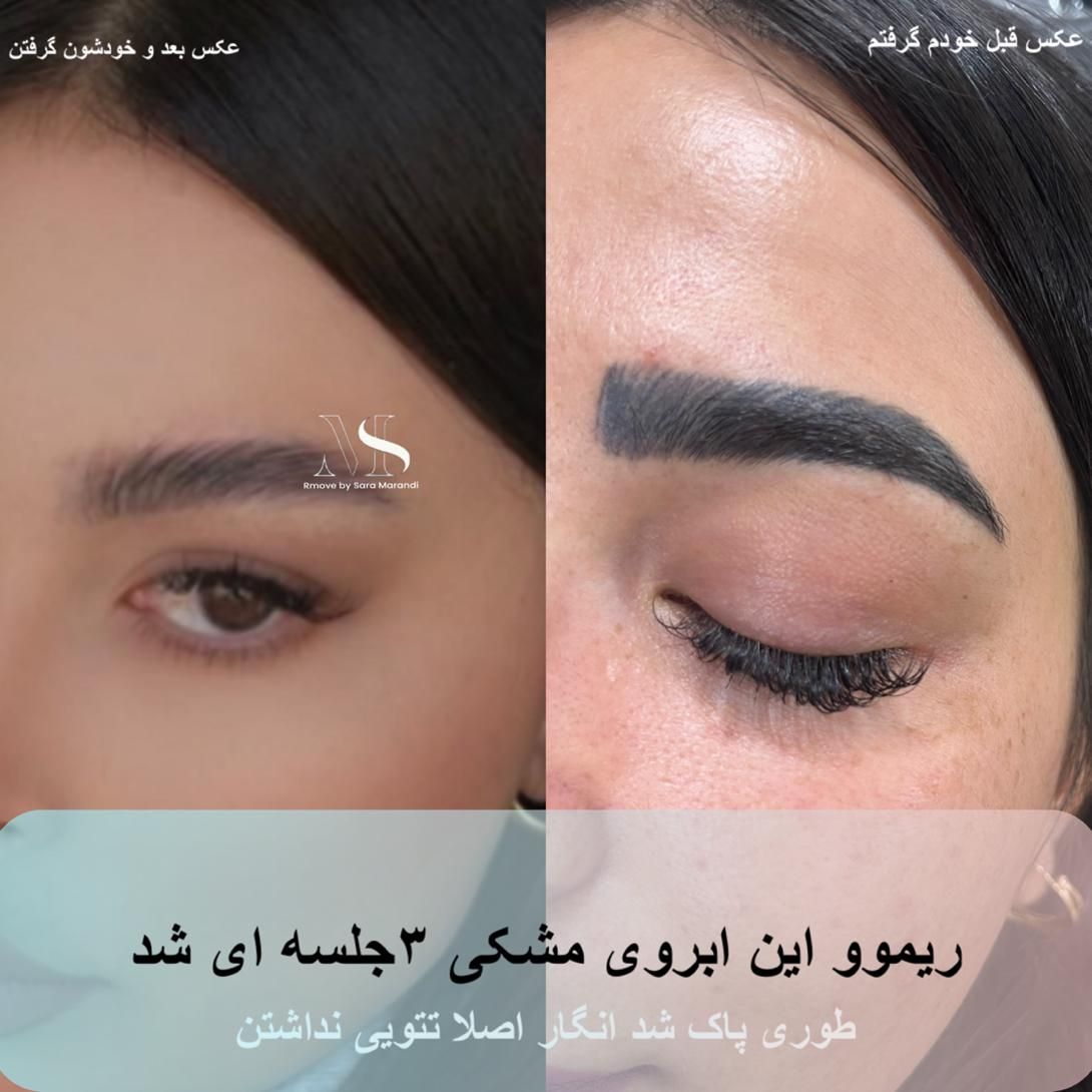 ریموو و پاک کردن تتوهای قدیمی|خدمات آرایشگری و زیبایی|تبریز, |دیوار